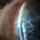 Intraepithelial epithelioma